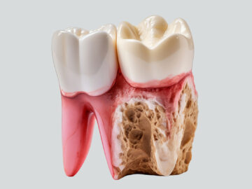 Signs of Infection After a Tooth Extraction and When to Call Your Dentist